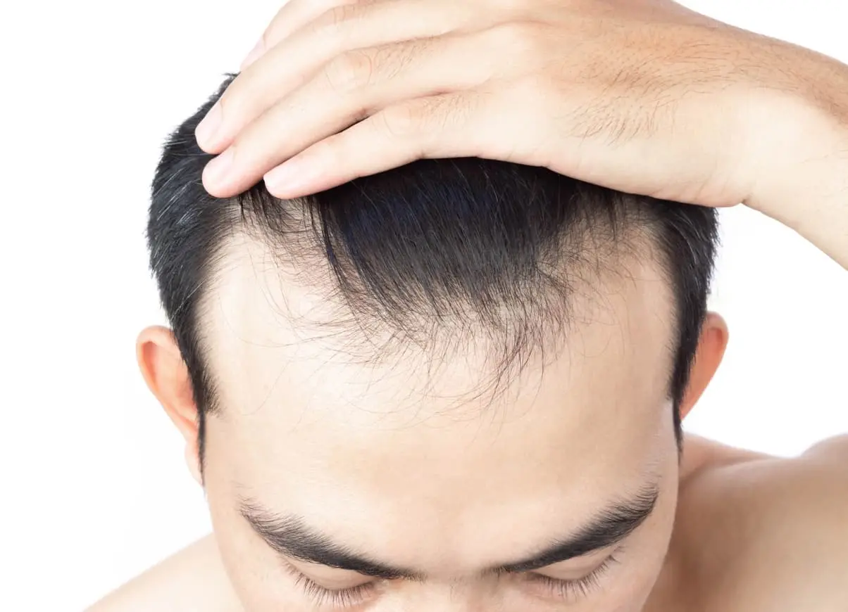 Man with receding hairline at the front of his head